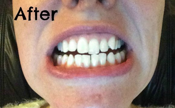 Smile Brilliant teeth