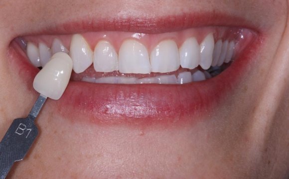 Crest 3d Teeth Whitening