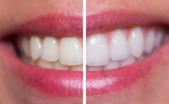 Hydrogen Peroxide Teeth