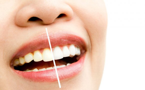 Can Teeth Whitening Damage