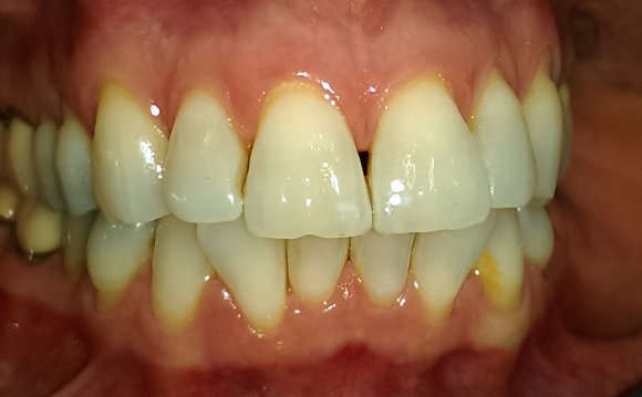 Teeth Whitening Western Dental