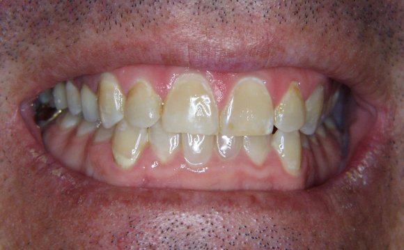 Beaming White Teeth Whitening