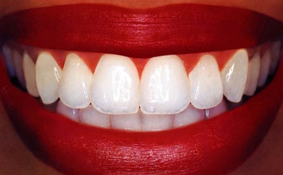 Laser Teeth whitening safe