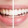 Cost Laser Teeth whitening