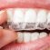 Cost of teeth Whitening