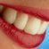 Dangers of Laser Teeth whitening