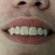 How to Whitening teeth with braces?