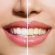 Laser Teeth whitening Essex