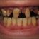 Laser treatment for Teeth whitening