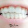 Professional Teeth Whitening results