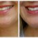 Teeth whitening strips coupons