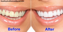 How to Naturally Whiten Your Teeth In 3 Minutes at Home