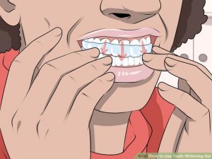 Image titled Use Teeth Whitening Gel Step 7