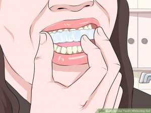 Image titled Use Teeth Whitening Gel Step 5