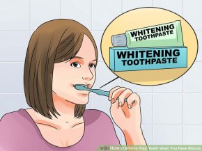 Image titled Whiten Your Teeth when You Have Braces Step 1