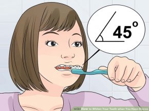 Image titled Whiten Your Teeth when You Have Braces Step 2