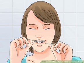Image titled Whiten Your Teeth when You Have Braces Step 3
