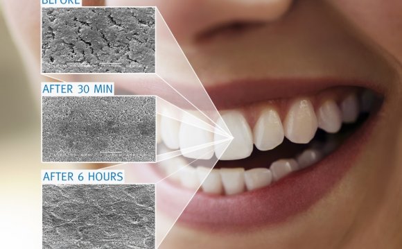 Does Dental whitening gel Work