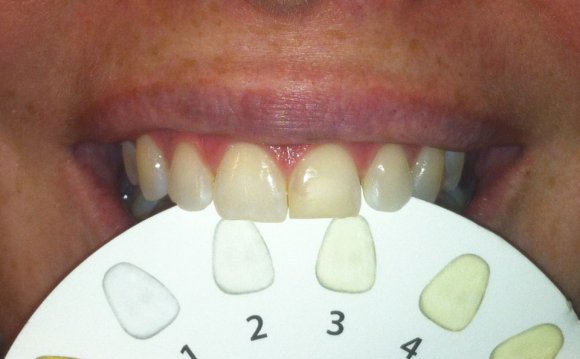 Dial a Smile Teeth Whitening Review