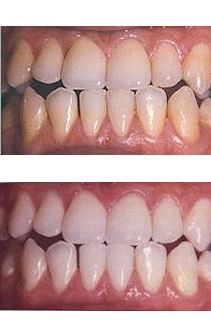 photos before & after - laser teeth whitening treatments