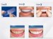 Best home teeth whitening System