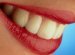 Dangers of Laser Teeth whitening