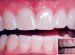 What hydrogen peroxide to Whitening teeth?