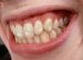 What is the best Teeth whitening gel?