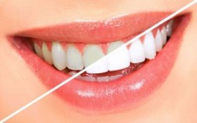 Pros and Cons of at-home and professional teeth whitening systems from a Kirkland dentist.