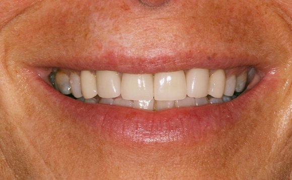 Teeth Whitening Side Effects