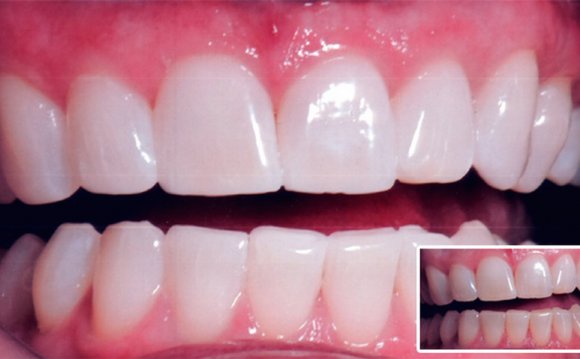 What hydrogen peroxide to Whitening teeth?