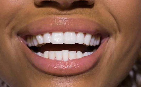 Teeth whitening strips Australia