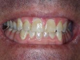 Best Teeth whitening gel Refills