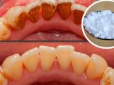 Can naturally yellow teeth be whitened?