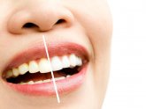 Can whitening strips damage teeth?