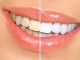Cheap teeth whitening products that work