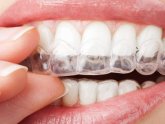 Cost of teeth Whitening