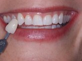 Cost of Teeth whitening trays from dentist