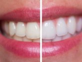 Hydrogen peroxide teeth Whitening