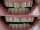 IWhite Teeth Whitening Reviews