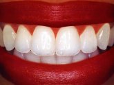 Laser whitening of Teeth