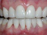 Side effects of Laser Teeth whitening