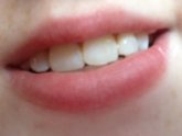 Smile Science Teeth Whitening Review