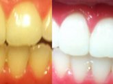 Teeth whitening home Remedy