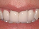 Teeth Whitening in Somerset