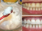 Teeth whitening naturally Fast
