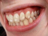 What is the best Teeth whitening gel?
